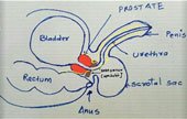 Trans Rectal Ultra Sound (TRU) guided Prostate Biopsy


