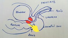 Rectal examination to feel for the prostate

